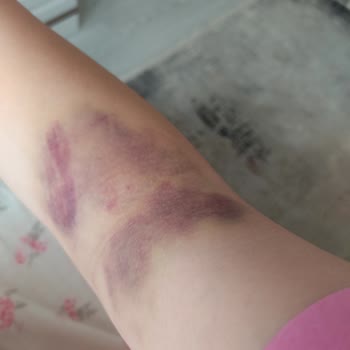 Türk Kızılay Kızılay'a Kan Verdim Ve Kolum Mahvoldu