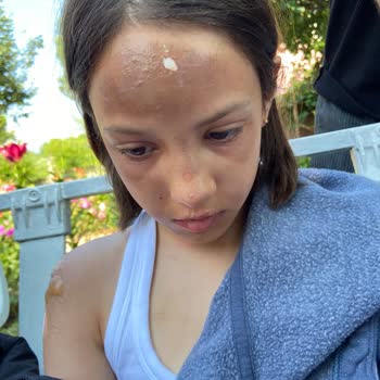 Nurgaz Kamp Tüpü Patlaması