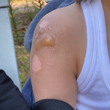 Nurgaz Kamp Tüpü Patlaması