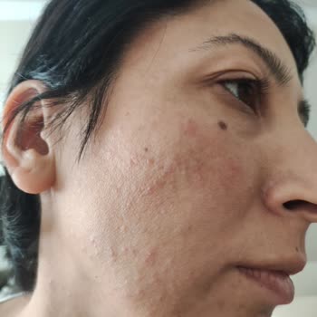 Trendyol Purest Marka Güneş Koruyucu Alerji Yaptı