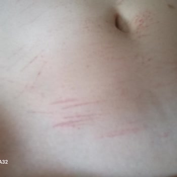 Queenez Sağlık Ve Güzellik Merkezi Tarafından İşlem Yapılırken Yanık Oluştu!