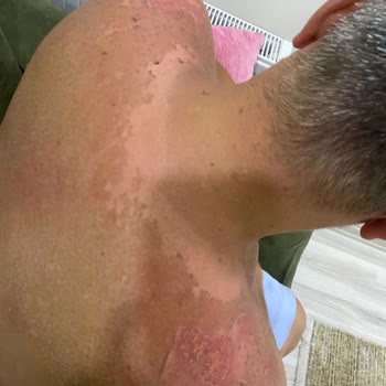 Ersağ Güneş Kreminin Vücudu Yakması