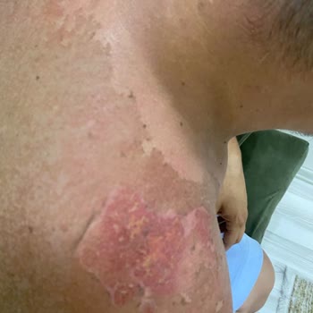 Ersağ Güneş Kreminin Vücudu Yakması