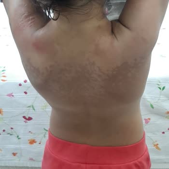 Ersağ Güneş Kreminin Vücudu Yakması