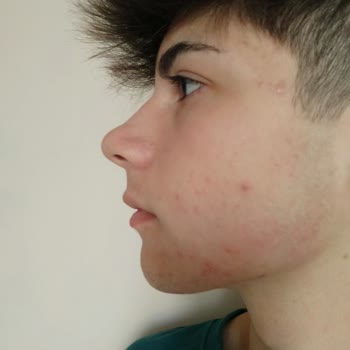 Ziaja Keçi Sutlu Tonik Ve Yüz Temizleme Jeli Neden Böyle Oldu Yüzüm