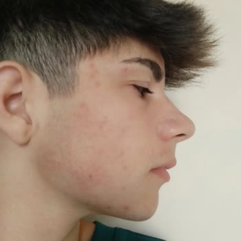 Ziaja Keçi Sutlu Tonik Ve Yüz Temizleme Jeli Neden Böyle Oldu Yüzüm