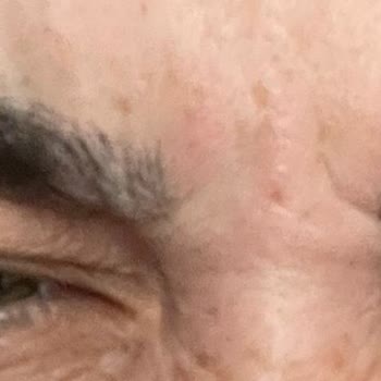 Dr. Ersin Işılar Kötü Botoks Deneyimim