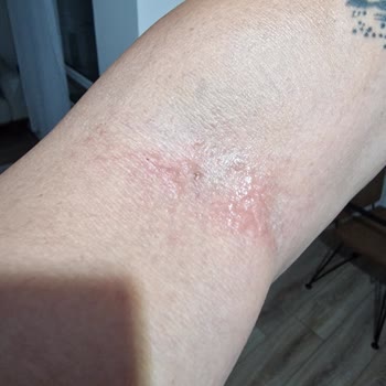 Sesu Acılar İçinde Yandık