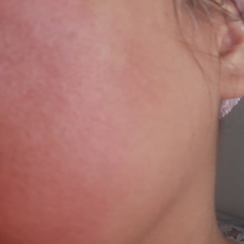 Deepclean Alerji Yaptı Yüzüm Kızarık Ve Yanmış Vaziyette