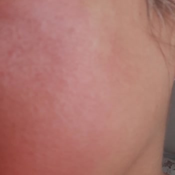 Deepclean Alerji Yaptı Yüzüm Kızarık Ve Yanmış Vaziyette