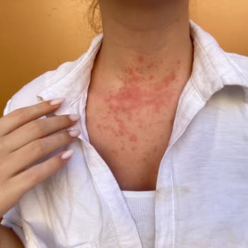 Eda Taşpınar Bronzlaştırıcısı Cildimi Mahvetti