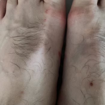 Birkenstock Terlik Ayağımı Yara Yaptı!