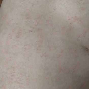 Novar Poliklinik Lazer Sonrası Vücudum Yandı