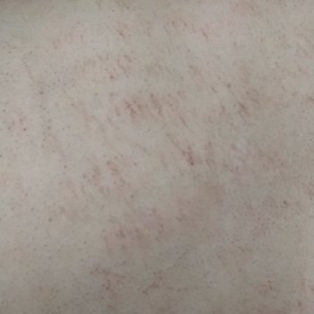 Novar Poliklinik Lazer Sonrası Vücudum Yandı