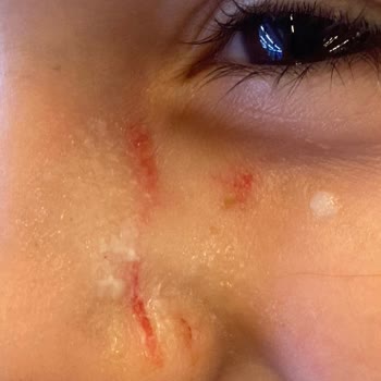 Ayme Karadeniz Lokantası İşletme Torunumun Yüzünü Parçaladı, Özür Bile Dilemedi!