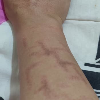 Aris Çukurambar Vip Lazer İşlemi Sonrası Kolumda Oluşan Yanık