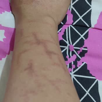 Aris Çukurambar Vip Lazer İşlemi Sonrası Kolumda Oluşan Yanık