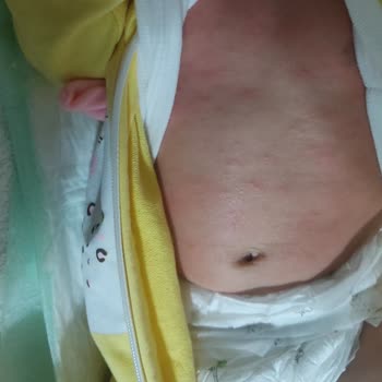 Mustela Hydra Bebe Avokadolu Nemlendirici Bebeğimde Egzama Yaptı.