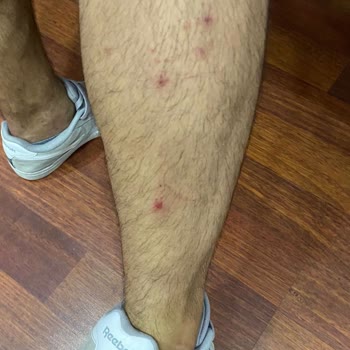 Uludağ Turizm Otobüsteki Tahta Kurusu Evimize Geldi