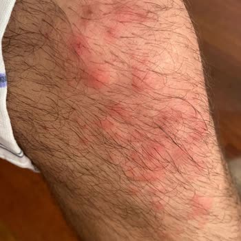 Uludağ Turizm Otobüsteki Tahta Kurusu Evimize Geldi