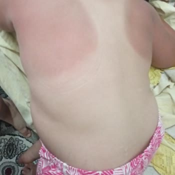 Dr. Öz Klinik Güneş Kremi Koruyuculuğu Sıfır