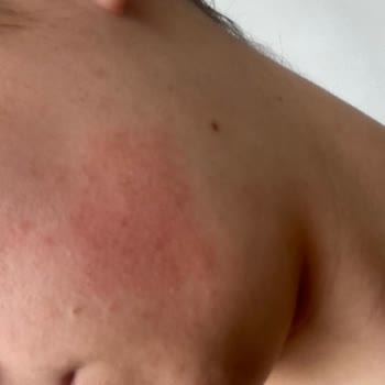 Loreal Paris Revitalif Lazer Saf Retinol Gece Serumu Yüzümü Mahvetti