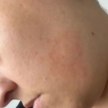 Loreal Paris Revitalif Lazer Saf Retinol Gece Serumu Yüzümü Mahvetti