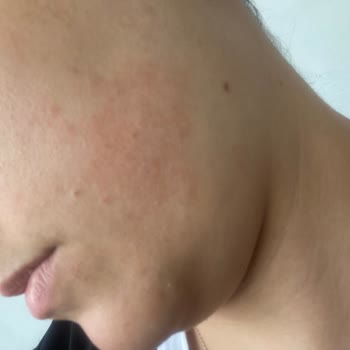 Loreal Paris Revitalif Lazer Saf Retinol Gece Serumu Yüzümü Mahvetti