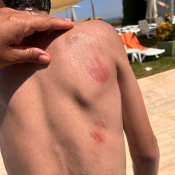 Ramada By Wyndham Tekirdağ Otel Kazası Ve Sorumsuzluk