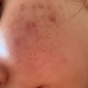 Liv Hospital Ankara Dermatolog Şikayetim