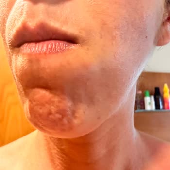 Eda Taşpınar Bomba Güneş Kremi Faciası