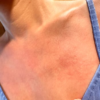 Eda Taşpınar Bomba Güneş Kremi Faciası