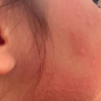 Enterogermina Çocuğumu Alerji Yaptı