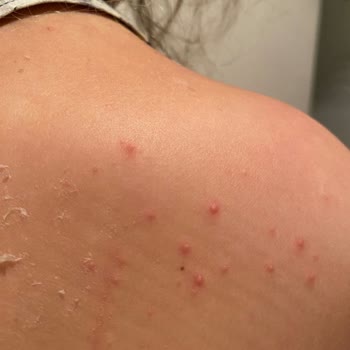 Gratis Eda Taşpınar Bronzlaştırıcı Spreyin Yanık Acısı