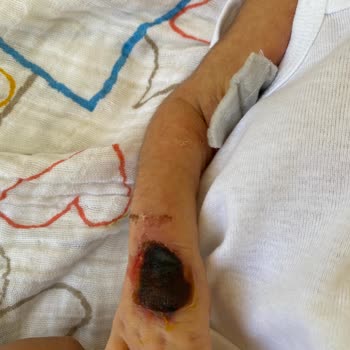 Özel Sekiz Eylül Hastanesi Küvezdeki Bebeğimin Kolunu Yaktı