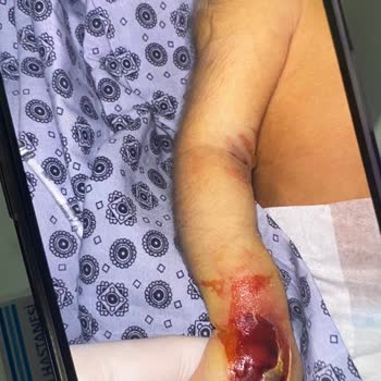 Özel Sekiz Eylül Hastanesi Küvezdeki Bebeğimin Kolunu Yaktı