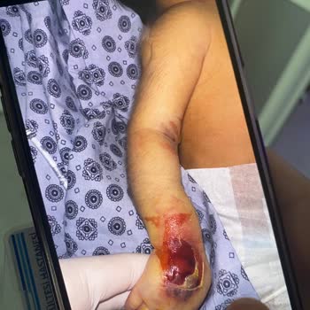 Özel Sekiz Eylül Hastanesi Küvezdeki Bebeğimin Kolunu Yaktı