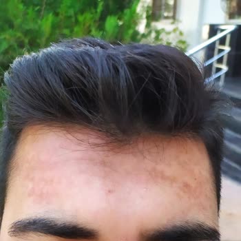 La Roche - Posay Yüz Jeli & Güneş Kremi Alerji Yaptı