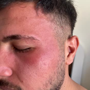 Nivea Krem Yüzümü Mahvetti Yara Çıkardı