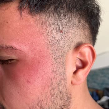 Nivea Krem Yüzümü Mahvetti Yara Çıkardı