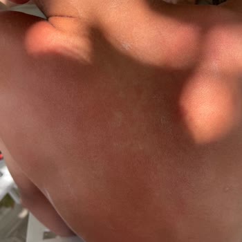 Mustela Güneş Kremi Şikayet