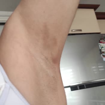 Dilan Polat Estetik Lazer Sonrası Kalıcı Leke