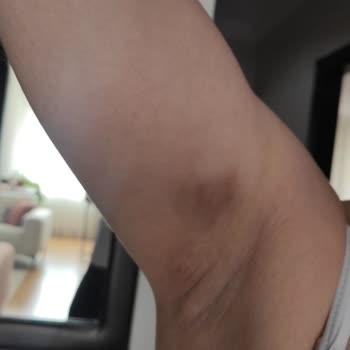 Dilan Polat Estetik Lazer Sonrası Kalıcı Leke