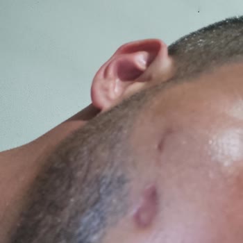 Enza Güzellik Merkezleri Lazer Epilasyon Yanığı