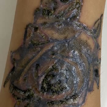 Nikarich Kozmetik Dövmem Silindi Ciddi Bir Yara Oldu