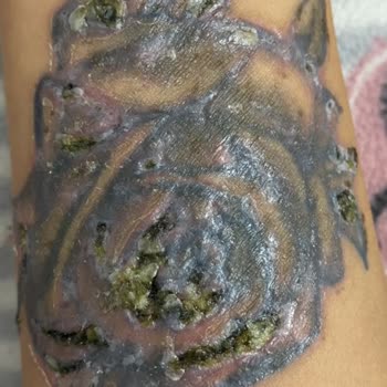 Nikarich Kozmetik Dövmem Silindi Ciddi Bir Yara Oldu