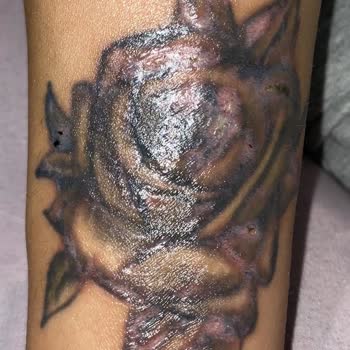 Nikarich Kozmetik Dövmem Silindi Ciddi Bir Yara Oldu