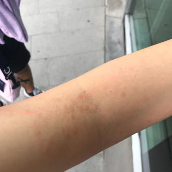 İstinye Üniversitesi Hastanesi Lazer Epilasyon Pişmanlığı