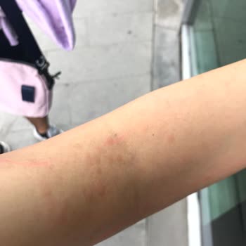 İstinye Üniversitesi Hastanesi Lazer Epilasyon Pişmanlığı