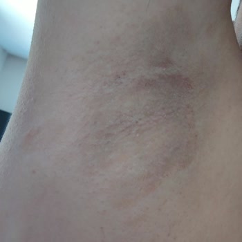 Rexona Deodorant Kaşıntı Kabarıklık